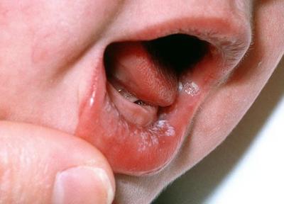 چگونه آفت دهان نوزاد را درمان کنیم؟